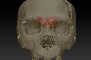 Seis cráneos de Atapuerca, objeto de trabajo en el primer estudio mundial que abarca todas las especies de la evolución humana en relación a senos frontales